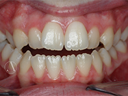 Before - Ali Orthodontics Dental