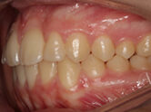 After - Ali Orthodontics Dental
