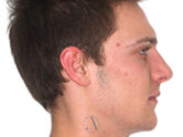 After - Ali Orthodontics Dental
