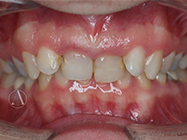 Before - Ali Orthodontics Dental