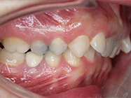 Before - Ali Orthodontics Dental