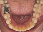 After - Ali Orthodontics Dental