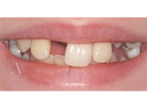 Before - Ali Orthodontics Dental